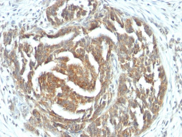 Formalin-fixed, paraffin-embedded human ovarian carcinoma stained with VEGF Mouse Monoclonal Antibody (VEGF/1063).