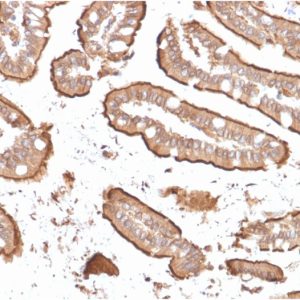 Formalin-fixed, paraffin-embedded human Small Intestinal Carcinoma stained with Villin-Monospecific Recombinant Mouse Monoclonal Antibody (rVIL1/1325).