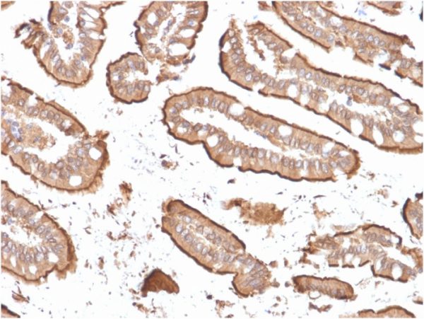 Formalin-fixed, paraffin-embedded human Small Intestinal Carcinoma stained with Villin-Monospecific Recombinant Mouse Monoclonal Antibody (rVIL1/1325).