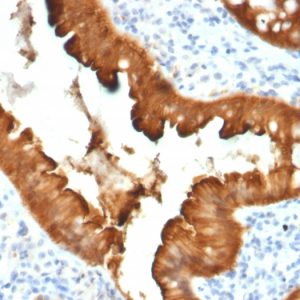 Formalin-fixed, paraffin-embedded human colon carcinoma stained with Villin Mouse Monoclonal Antibody (VIL1/2376). HIER: Tris/EDTA, pH9.0, 45min. 2°C: HRP-polymer, 30min. DAB, 5min.