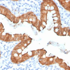 Formalin-fixed, paraffin-embedded human colon adenocarcinoma stained with Villin Recombinant Rabbit Monoclonal Antibody (VIL1/4107R).