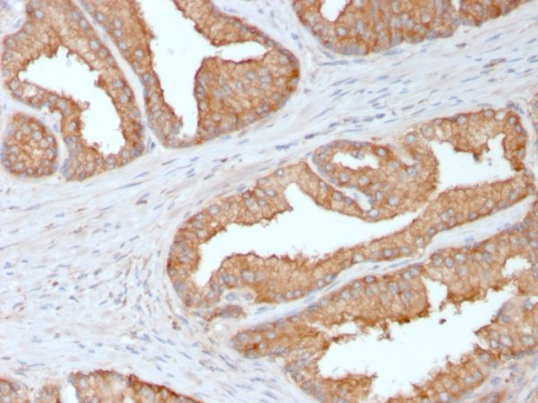 Formalin-fixed, paraffin-embedded human Prostate Carcinoma stained with Ezrin Mouse Monoclonal Antibody (CPTC-Ezrin-1).