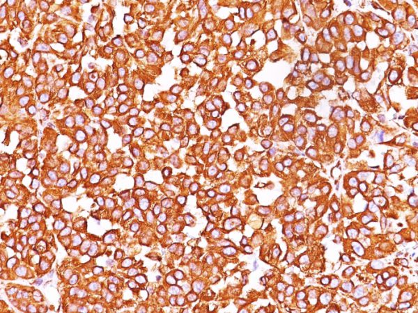 Formalin-fixed, paraffin-embedded human Melanoma stained with Vimentin Monoclonal Antibody (SPM576)