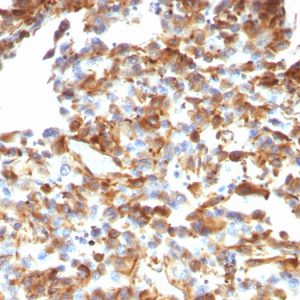 Formalin-fixed, paraffin-embedded human Melanoma stained with Vimentin Mouse Monoclonal Antibody (VM1170).