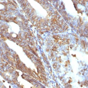 Formalin-fixed, paraffin-embedded human uterine carcinoma stained with Vimentin Mouse Monoclonal Antibody (V9).
