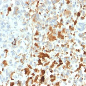 Formalin-fixed, paraffin-embedded human melanoma stained with Vimentin Rabbit Recombinant Monoclonal Antibody (VIM/1937R).