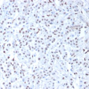 Formalin-fixed, paraffin-embedded human Mesothelioma stained with Wilm&apos;s Tumor Mouse Monoclonal Antibody (6F-H2).