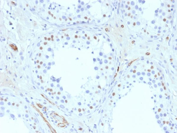 Formalin-fixed, paraffin-embedded human Testis stained with Wilm&apos;s Tumor Mouse Monoclonal Antibody (6F-H2).