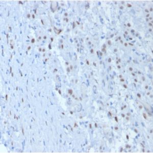 Formalin-fixed, paraffin-embedded human Mesothelioma stained with Wilm&apos;s TumorMonoclonal Antibody (SPM361).