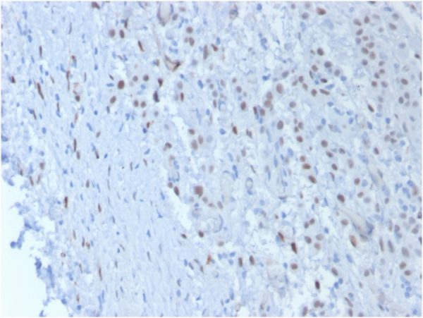Formalin-fixed, paraffin-embedded human Mesothelioma stained with Wilm&apos;s TumorMonoclonal Antibody (SPM361).