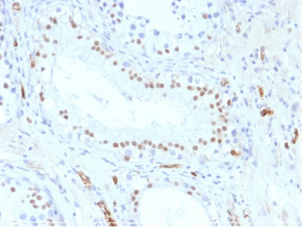 Formalin-fixed, paraffin-embedded HumanTestis stained with Wilm&apos;s Tumor Mouse Monoclonal Antibody (WT1/857).