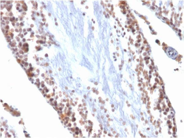 Formalin-fixed, paraffin-embedded Rat Testis stained with Wilm&apos;s Tumor Mouse Monoclonal Antibody (WT1/857).