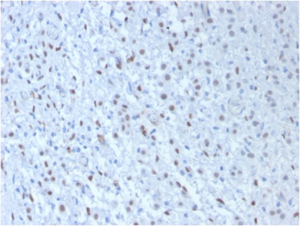 Formalin-fixed, paraffin-embedded human Mesothelioma stained with Wilm&apos;s TumorMonoclonal Antibody (WT1/857 + 6F-H2).