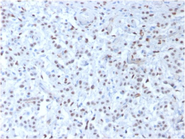 Formalin-fixed, paraffin-embedded human Mesothelioma stained with Wilm&apos;s Tumor Mouse Recombinant Monoclonal Antibody (rWT1/857).