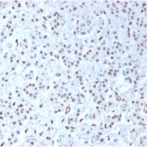 Formalin-fixed, paraffin-embedded human mesothelioma stained with Wilm&apos;s Tumor Rabbit Recombinant Monoclonal Antibody (WT1/1434R).