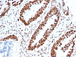 Formalin-fixed, paraffin-embedded human ovarian carcinoma stained with Wilm&apos;s Tumor Recombinant Rabbit Monoclonal Antibody (WT1/3477R). Inset: PBS instead of primary, secondary negative control.