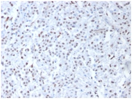 Formalin-fixed, paraffin-embedded human Mesothelioma stained with Wilm&apos;s Tumor Rabbit Polyclonal Antibody Antibody.