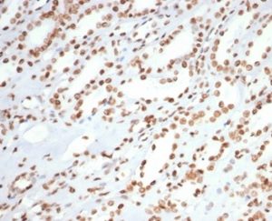 Formalin-fixed, paraffin-embedded human colon carcinoma stained with XRCC5 / Ku86 / Ku80 Mouse Monoclonal Antibody (XRCC5/7315). HIER: Tris/EDTA, pH9.0, 45min. 2°C: HRP-polymer, 30min. DAB, 5min.