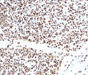 Formalin-fixed, paraffin-embedded human lymph node stained with XRCC5 / Ku86 / Ku80 Mouse Monoclonal Antibody (XRCC5/7317). HIER: Tris/EDTA, pH9.0, 45min. 2 °: HRP-polymer, 30min. DAB, 5min.