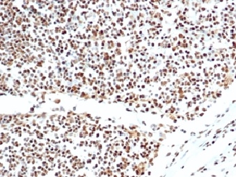Formalin-fixed, paraffin-embedded human lymph node stained with XRCC5 / Ku86 / Ku80 Mouse Monoclonal Antibody (XRCC5/7317). HIER: Tris/EDTA, pH9.0, 45min. 2 °: HRP-polymer, 30min. DAB, 5min. XRCC5 (Ku86 / Ku80) (Thyroid-Lupus Autoantigen) Antibody