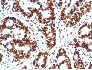 Formalin-fixed, paraffin-embedded human colon carcinoma stained with XRCC5 / Ku86 / Ku80 Mouse Monoclonal Antibody (XRCC5/7317). HIER: Tris/EDTA, pH9.0, 45min. 2 °: HRP-polymer, 30min. DAB, 5min. XRCC5 (Ku86 / Ku80) (Thyroid-Lupus Autoantigen) Antibody - Image 4