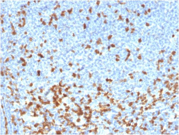 Formalin-fixed, paraffin-embedded human lymphoma stained with ZAP70 Recombinant Mouse Monoclonal Antibody (rZAP70/2046).