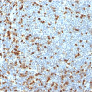Formalin-fixed, paraffin-embedded human lymphoma stained with ZAP70 Recombinant Rabbit Monoclonal Antibody (ZAP70/3921R).