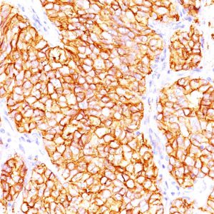 Formalin-fixed, paraffin-embedded human Renal Cell Carcinoma stained with RCC Mouse Monoclonal Antibody (66.4.C2). HIER: Tris/EDTA, pH9.0, 45min. 2°C: HRP-polymer, 30min. DAB, 5min.