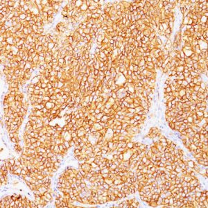 Formalin-fixed, paraffin-embedded human Renal Cell Carcinoma stained with RCC Monoclonal Antibody (SPM314).