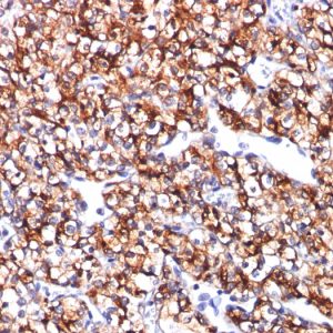 Formalin-fixed, paraffin-embedded human Renal Cell Carcinoma stained with CAIX Mouse Monoclonal Antibody (CA9/781).