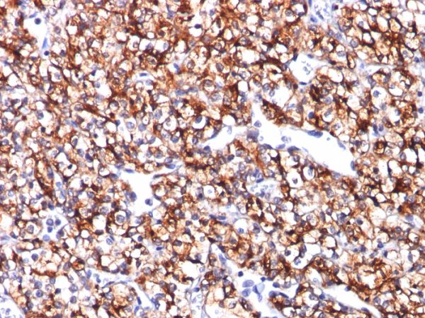 Formalin-fixed, paraffin-embedded human Renal Cell Carcinoma stained with CAIX Mouse Monoclonal Antibody (CA9/781).