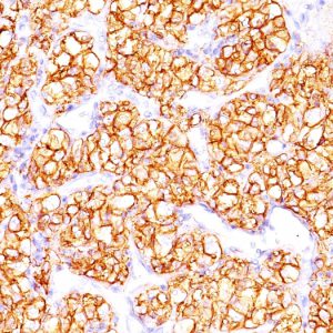 Formalin-fixed, paraffin-embedded human Renal Cell Carcinoma stained with PNA Mouse Monoclonal Antibody (PN-15).