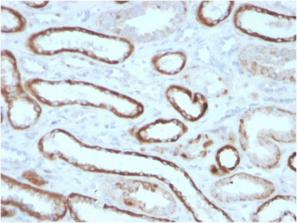 Formalin-fixed, paraffin-embedded human Renal Cell Carcinoma Stained with CAIX-Monospecific Mouse Monoclonal Antibody (CA9/3405).
