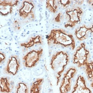 Formalin-fixed, paraffin-embedded human Renal Cell Carcinoma stained with RCC Rabbit Recombinant Monoclonal Antibody (CA9/2993R).