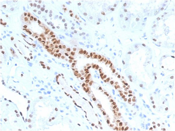 Formalin-fixed, paraffin-embedded human Renal Cell Carcinoma stained with PAX8 Mouse Monoclonal Antibody (PAX8/1491).