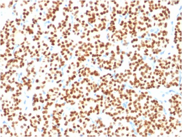 Formalin-fixed, paraffin-embedded human thyroid carcinoma stained with PAX8 Mouse Monoclonal Antibody (PAX8/1491).