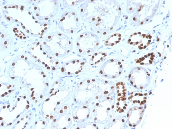 Formalin-fixed, paraffin-embedded human Renal Cell Carcinoma stained with PAX8 Mouse Monoclonal Antibody (PAX8/1492).