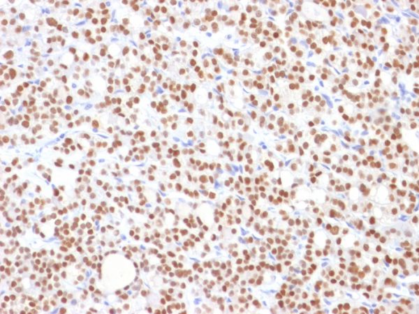 Formalin-fixed, paraffin-embedded human Thyroid Carcinoma stained with PAX8 Mouse Monoclonal Antibody (PAX8/1492).