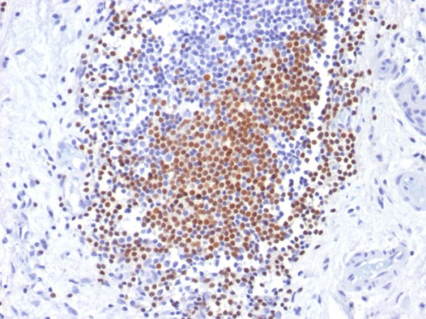 Formalin-fixed, paraffin-embedded human Urothelial Carcinoma stained with PAX8 Mouse Monoclonal Antibody (PAX8/1492).