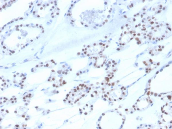 Formalin-fixed, paraffin-embedded human thyroid stained with PAX8 Recombinant Mouse Monoclonal Antibody (rPAX8/3687).