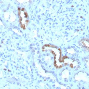 Formalin-fixed, paraffin-embedded human kidney stained with Calbindin 1 Mouse Monoclonal Antibody (CALB1/3333). HIER: Tris/EDTA, pH9.0, 45min. 2°C: HRP-polymer, 30min. DAB, 5min.