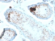 Formalin-fixed, paraffin-embedded human Testicular Carcinoma stained with Calretinin Mouse Monoclonal Antibody (CALB2/2685).