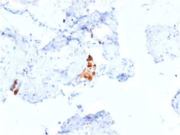Formalin-fixed, paraffin-embedded human Testicular Carcinoma stained with Calretinin Mouse Monoclonal Antibody (CALB2/2807).