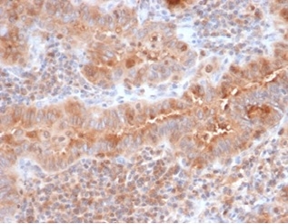 Formalin-fixed, paraffin-embedded human thyroid stained with  Calcitonin Mouse Monoclonal Antibody (CALCA/3310). HIER: Tris/EDTA, pH9.0, 45min. 2 °: HRP-polymer, 30min. DAB, 5min.