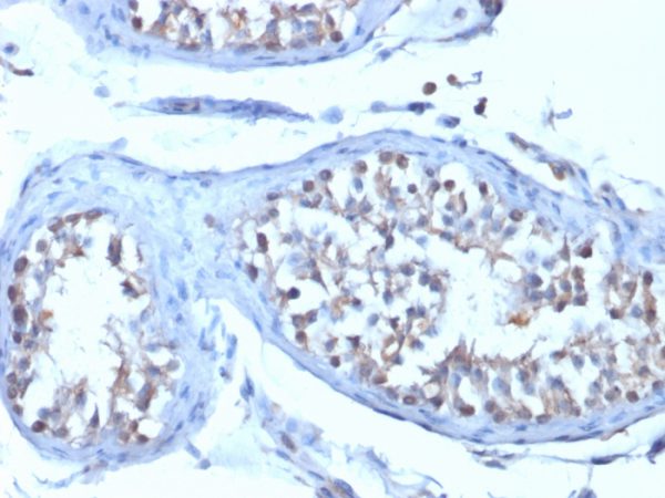 Formalin-fixed, paraffin-embedded human Testicular Carcinoma stained with B7-H4 Mouse Monoclonal Antibody (B7H4/1788).
