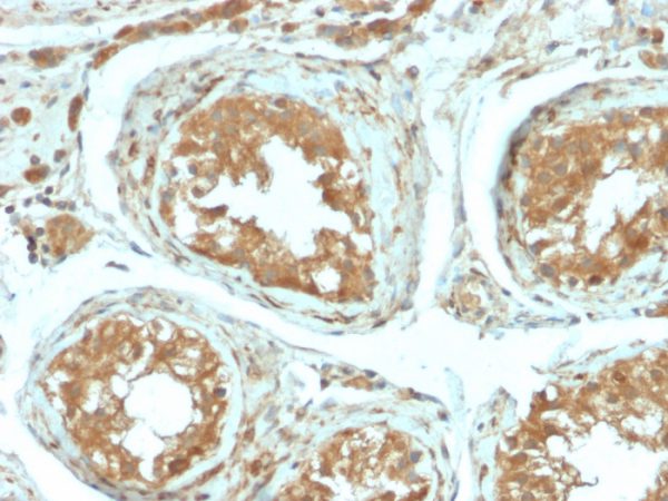 Formalin-fixed, paraffin-embedded human Testicular Carcinoma stained with B7-H4 Rabbit Recombinant Monoclonal Antibody (B7H4/2652R).