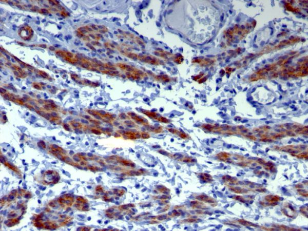 Formalin-fixed, paraffin-embedded human Leiomyosarcoma stained with Caldesmon Mouse Monoclonal Antibody (h-CALD).