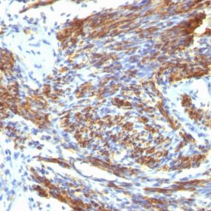 Formalin-fixed, paraffin-embedded human Leiomyosarcoma stained with Caldesmon Mouse Monoclonal Antibody (CALD1/820).