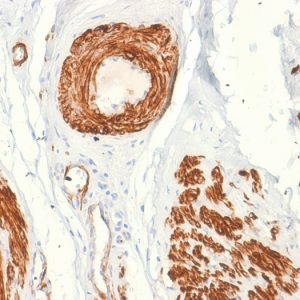 Formalin-fixed, paraffin-embedded human Leiomyosarcoma stained with Caldesmon Mouse Recombinant Monoclonal Antibody (rCALD1/820).