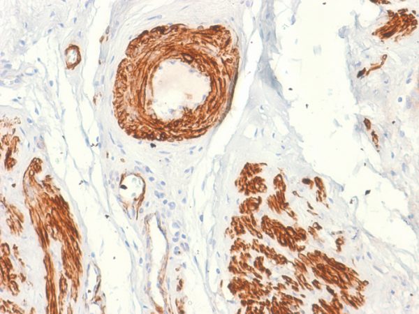 Formalin-fixed, paraffin-embedded human Leiomyosarcoma stained with Caldesmon Mouse Recombinant Monoclonal Antibody (rCALD1/820).